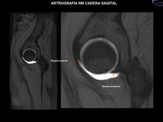 Anatomia artrorm cadera | PPT