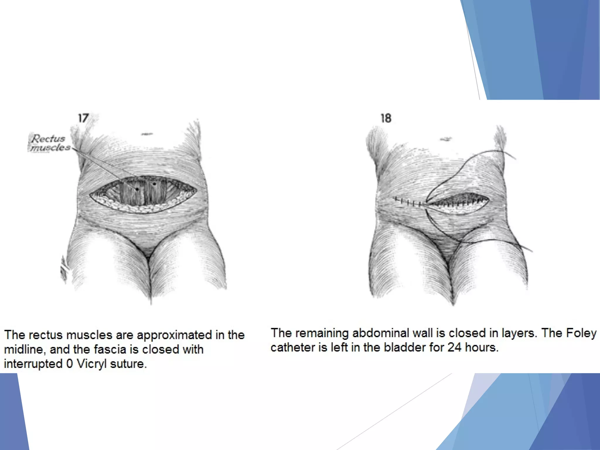 Orr Incision Abdominal incision and abdominal anatomy | PPT