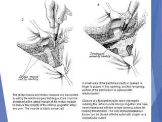 Abdominal incision and abdominal anatomy | PPT