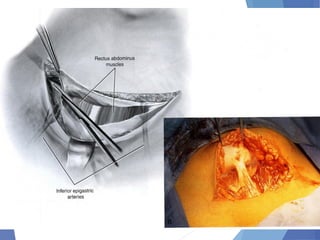 Abdominal incision and abdominal anatomy | PPT