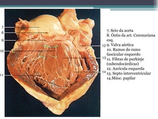 7. Seio da aorta
8. Óstio da art. Coronariana
esq.
9. Valva aórtica
10. Ramos do ramo
fascicular esquerdo
11. Fibras de purkinje
(subendocárdicas)
12. Aurícula esquerda
13. Septo interventricular
14.Músc. papilar
 