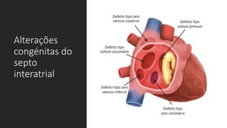 Alterações
congénitas do
septo
interatrial
 