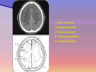 1: hoz cerebral 
2:hueso parietal 
3:hueso sutural 
4 : Corona radiada 
5: Lobulo frontal 
Corte 10  