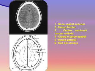 1 : Seno sagital superior 2 : Hueso frontal 3 : Centro semioval/ corona radiada 4 : Cisura o surco central 5 : Hueso parietal 6 : Hoz del cerebro  