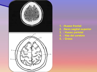 1.:Hueso frontal 
2.:Seno sagital superior 
3.: Hueso parietal 
4.: Haz del cerebro 
5.: Grasa  