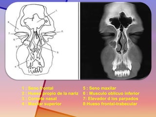 1 : Seno frontal 2 : Hueso propio de la nariz 3 : Cornete nasal 4 : Maxilar superior 5 : Seno maxilar 6 : Musculo oblicuo inferior 7: Elevador d los parpados 8:Hueso frontal-trabecular  