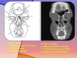 1: Seno frontal 2 : Hueso propio de la nariz 3 : Cornete nasal 4 : Maxilar superior 5 : Seno maxilar 6 : Musculo oblicuo inferior 7 : Elevador de los parpados 8: Hueso frontal-trabecula  