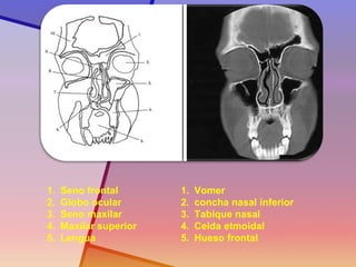 1.Seno frontal 
2.Globo ocular 
3.Seno maxilar 
4.Maxilar superior 
5.Lengua 
1.Vomer 
2.concha nasal inferior 
3.Tabique nasal 
4.Celda etmoidal 
5.Hueso frontal  