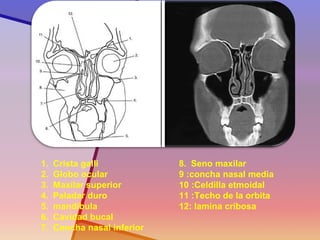 1.Crista galli 
2.Globo ocular 
3.Maxilar superior 
4.Paladar duro 
5.mandíbula 
6.Cavidad bucal 
7.Concha nasal inferior 
8.Seno maxilar 9 :concha nasal media 10 :Celdilla etmoidal 11 :Techo de la orbita 12: lamina cribosa  