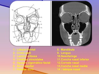 1.Lóbulo frontal 
2.Crista galli 
3.Lamina cribosa 
4.Celdillas etmoidales 
5.Agujero cigomático facial 
6.Seno maxilar 
7.Paladar duro 
8.Mandíbula 
9.Lengua 
10.Nasofaringe 
11.Concha nasal inferior 
12.Cornete nasal 
13.Concha nasal media 14 : tabique nasal  