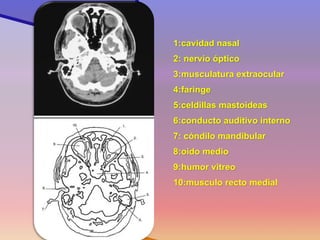 1:cavidad nasal 
2: nervio óptico 
3:musculatura extraocular 
4:faringe 
5:celdillas mastoideas 
6:conducto auditivo interno 
7: cóndilo mandibular 
8:oido medio 
9:humor vitreo 
10:musculo recto medial 
Corte 3  