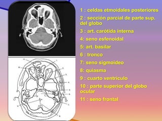 Corte 4 
1 : celdas etmoidales posteriores 
2 : sección parcial de parte sup. del globo 
3 : art. carótida interna 
4: seno esfenoidal 
5: art. basilar 
6 : tronco 
7: seno sigmoideo 
8: quiasma 
9 : cuarto ventrículo 
10 : parte superior del globo ocular 
11 : seno frontal 
 