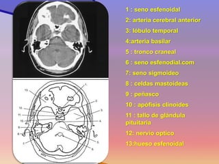 1 : seno esfenoidal 
2: arteria cerebral anterior 
3: lóbulo temporal 
4:arteria basilar 
5 : tronco craneal 
6 : seno esfenodial.com 
7: seno sigmoideo 
8 : celdas mastoideas 
9 : peñasco 
10 : apófisis clinoides 
11 : tallo de glándula pituitaria 
12: nervio optico 
13:hueso esfenoidal  