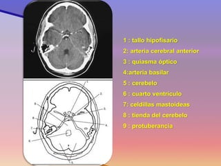 Corte 6 
1 : tallo hipofisario 
2: arteria cerebral anterior 
3 : quiasma óptico 
4:arteria basilar 
5 : cerebelo 
6 : cuarto ventrículo 
7: celdillas mastoideas 
8 : tienda del cerebelo 
9 : protuberancia  