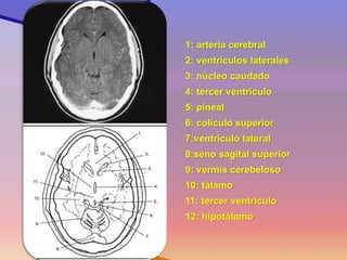 1: arteria cerebral 
2: ventrículos laterales 
3: núcleo caudado 
4: tercer ventrículo 
5: pineal 
6: coliculo superior 
7:ventriculo lateral 
8:seno sagital superior 
9: vermis cerebeloso 
10: tálamo 
11: tercer ventrículo 
12: hipotálamo 
Corte 7  