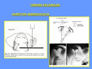 ASPECTOS RADIOLOGICOS CINTURA ESCAPULAR 