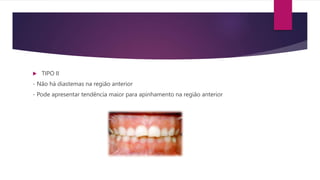 TIPO II
- Não há diastemas na região anterior
- Pode apresentar tendência maior para apinhamento na região anterior
 
