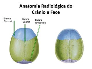 Anatomia Radiológica do
Crânio e Face
Sutura
Coronal
Sutura
Sagital
Sutura
lambdóide
 