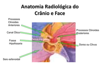 Anatomia Radiológica do
Crânio e Face
Processos Clinoides
Posteriores
Dorso ou Clivus
Seio esfenoidal
Fossa
Hipofissaria
Processos
Clinoides
Anteriores
Canal Ótico
 