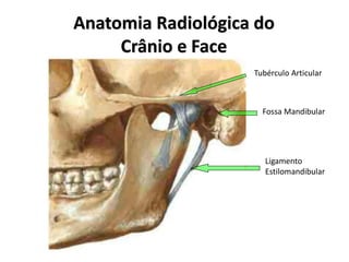 Anatomia Radiológica do
Crânio e Face
Tubérculo Articular
Fossa Mandibular
Ligamento
Estilomandibular
 