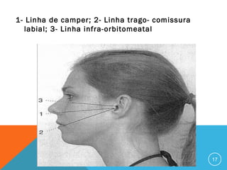 1- Linha de camper; 2- Linha trago- comissura
labial; 3- Linha infra-orbitomeatal

17

 