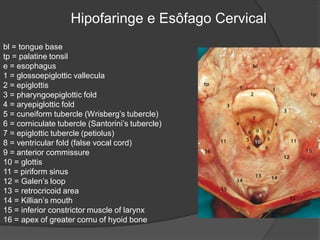 Hipofaringe e Esôfago Cervical
bl = tongue base
tp = palatine tonsil
e = esophagus
1 = glossoepiglottic vallecula
2 = epiglottis
3 = pharyngoepiglottic fold
4 = aryepiglottic fold
5 = cuneiform tubercle (Wrisberg’s tubercle)
6 = corniculate tubercle (Santorini’s tubercle)
7 = epiglottic tubercle (petiolus)
8 = ventricular fold (false vocal cord)
9 = anterior commissure
10 = glottis
11 = piriform sinus
12 = Galen’s loop
13 = retrocricoid area
14 = Killian’s mouth
15 = inferior constrictor muscle of larynx
16 = apex of greater cornu of hyoid bone
 