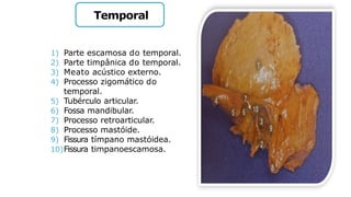 Temporal
1) Parte escamosa do temporal.
2) Parte timpânica do temporal.
3) Meato acústico externo.
4) Processo zigomático do
temporal.
5) Tubérculo articular.
6) Fossa mandibular.
7) Processo retroarticular.
8) Processo mastóide.
9) Fissura tímpano mastóidea.
10)Fissura timpanoescamosa.
 