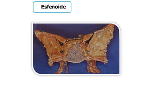 Esfenoide
 