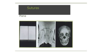 Suturas
Plana
 