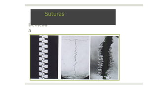 Dentead
a
Suturas
 