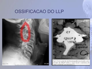 OSSIFICACAO DO LLP
 