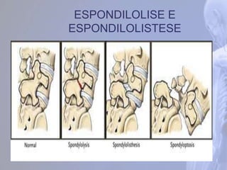 ESPONDILOLISE E
ESPONDILOLISTESE
 