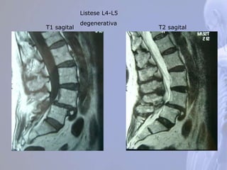 T1 sagital T2 sagital
Listese L4-L5
degenerativa
 