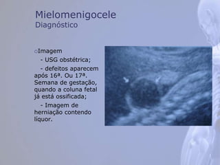 Mielomenigocele
Diagnóstico
Imagem
- USG obstétrica;
- defeitos aparecem
após 16ª. Ou 17ª.
Semana de gestação,
quando a coluna fetal
já está ossificada;
- Imagem de
herniação contendo
líquor.
 
