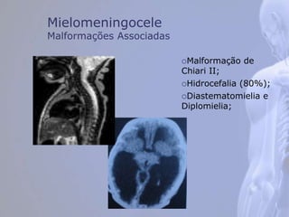 Mielomeningocele
Malformações Associadas
Malformação de
Chiari II;
Hidrocefalia (80%);
Diastematomielia e
Diplomielia;
 