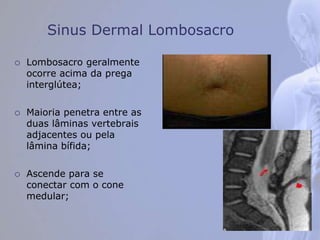 Sinus Dermal Lombosacro
 Lombosacro geralmente
ocorre acima da prega
interglútea;
 Maioria penetra entre as
duas lâminas vertebrais
adjacentes ou pela
lâmina bífida;
 Ascende para se
conectar com o cone
medular;
 