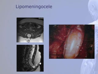 Lipomeningocele
 