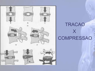 TRACAO
COMPRESSAO
X
 