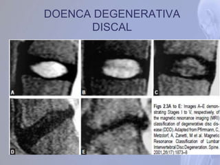 DOENCA DEGENERATIVA
DISCAL
 