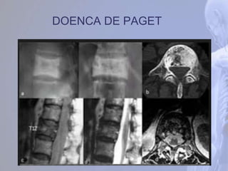 DOENCA DE PAGET
 