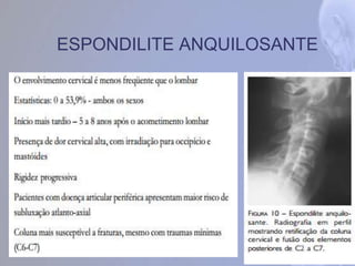 ESPONDILITE ANQUILOSANTE
 