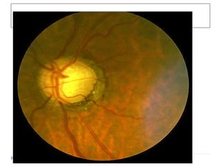 Glaucoma
 