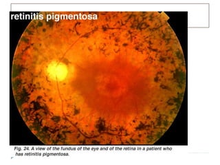 Retinose Pigmentar
 