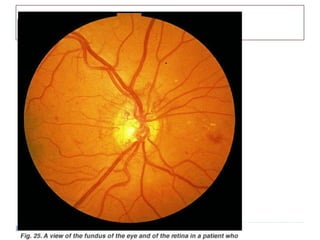 Retinopatia Diabética
 
