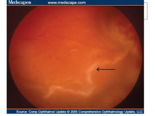 DESCOLAMENTO DE VÍTREO POSTERIOR
   Adelgaçamento das fibras colágenas

   Desprendimento da hialóide posterior

   Moscas volantes

   Expectante ou Vitrectomia
 