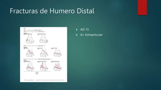Fracturas de Humero Distal
 AO 13
 A= Extraarticular
 