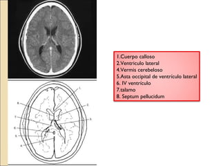 1.Cuerpo calloso 
2.Ventriculo lateral 
4.Vermis cerebeloso 
5.Asta occipital de ventrículo lateral 
6. IV ventrículo 
7.talamo 
8. Septum pellucidum 
 