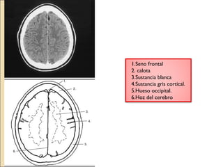 1.Seno frontal 
2. calota 
3.Sustancia blanca 
4.Sustancia gris cortical. 
5.Hueso occipital. 
6.Hoz del cerebro 
 