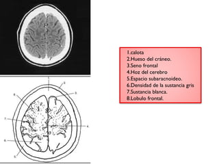1.calota 
2.Hueso del cráneo. 
3.Seno frontal 
4.Hoz del cerebro 
5.Espacio subaracnoideo. 
6.Densidad de la sustancia gris 
7.Sustancia blanca. 
8.Lobulo frontal. 
 