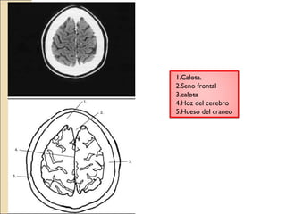 1.Calota. 
2.Seno frontal 
3.calota 
4.Hoz del cerebro 
5.Hueso del craneo 
 